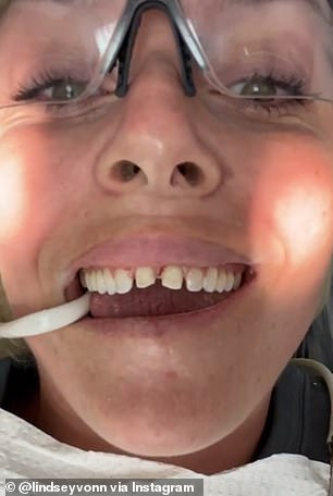 Before and after: Lindsay Vaughn, 35, shared a behind-the-scenes video of her wearing veneers on her front teeth