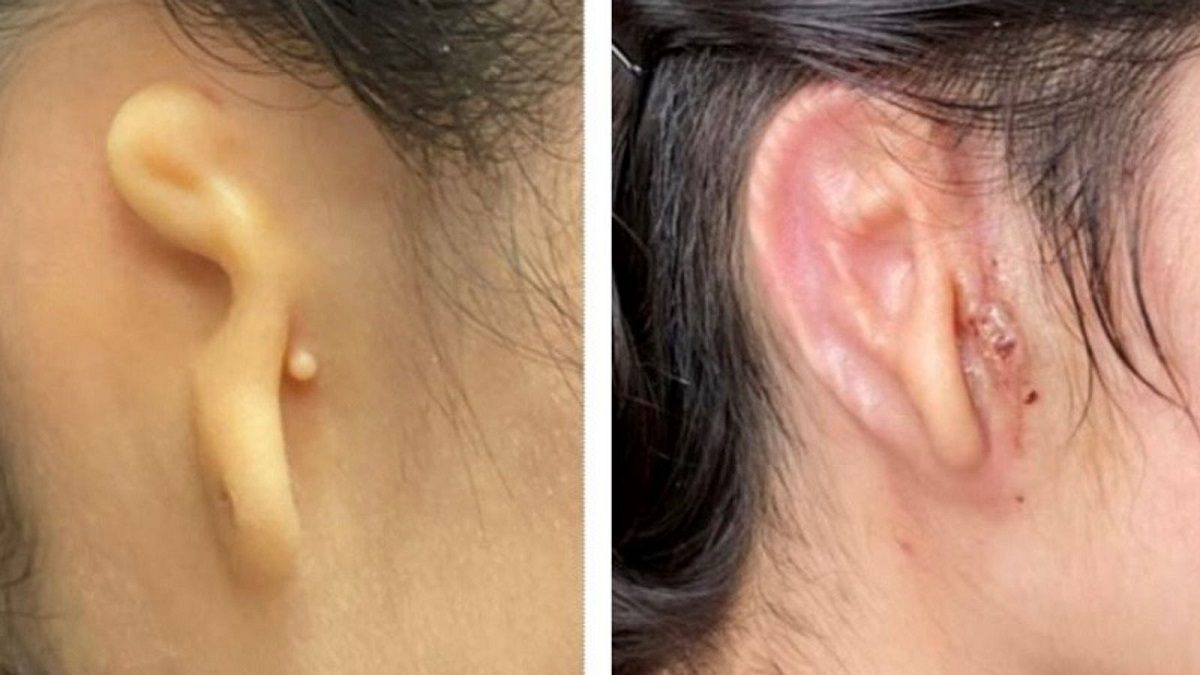 Successful Ear Transplant Microtia-Congenital Ear Institute and 3DBio Therapeutics