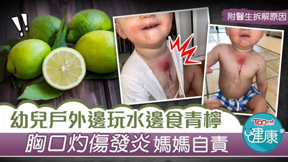 【食用】 男童 青檸 灼傷 發炎 媽媽 留意 「瑪格麗塔 燒傷」 – 香港 經濟 日報 – TOPick – 健康 – 食用 安全